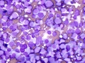Epitheliotropic lymphoma