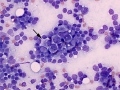Gastric carcinoma