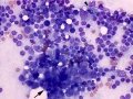 Gastric carcinoma