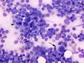 Gastric carcinoma