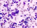 Hemorrhage & necrosis