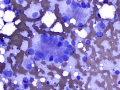 Hepatocellular carcinoma (presumptive)