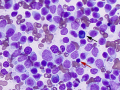 Lymphoma (T cell, aggressive, DQ)