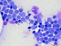 Lymphoma (T cell, aggressive)