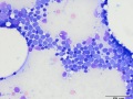 Lymphoma (T cell, aggressive)