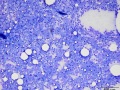 Lymphoma (T cell, aggressive)