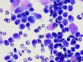 Lymphoma (T cell, aggressive, rapid stain)