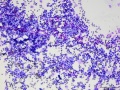 Lymphoma (T cell, aggressive, rapid stain)