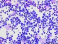 Lymphoma (T cell, aggressive, rapid stain)
