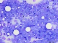 Lymphoma (T cell, aggressive)