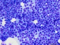 Lymphoma (T cell, aggressive, rapid stain)
