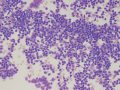 Lymphoma (indolent T zone)