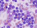 Lymphoma 1 month later