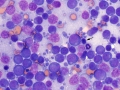 Lymphoma at diagnosis (B cell, aggressive)