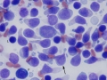 Lymphoma (indolent T zone)