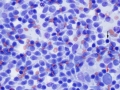 Lymphoma (indolent T zone)