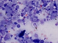 Acute myeloid leukemia