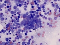 Lymphadenitis
