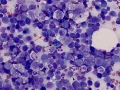 Lymphadenitis