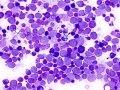 Lymphoma with mott cell differentiation