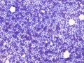 Lymphoma (suspect T cell, DQ)