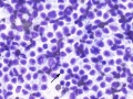 Lymphoma (suspect T cell, DQ)