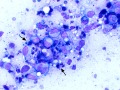Lymphoma & necrosis (DQ)
