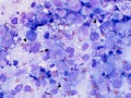 Lymphoma & necrosis
