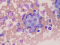 Nephroblastoma (presumptive)