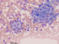 Nephroblastoma (presumptive)