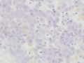 Urothelial carcinoma (ALP stain)