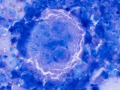 Metastatic carcinoma (cat)