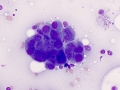 Nasal carcinoma