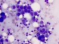Nasal carcinoma