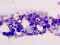 Nasal carcinoma