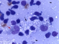 Granulomatous lymphadenitis & Mycobacteria