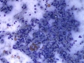 Granulomatous lymphadenitis & Mycobacteria
