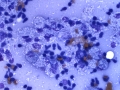 Granulomatous lymphadenitis & Mycobacteria