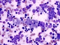 Necrosis