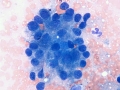 Pancreatic carcinoma