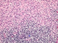 Mycobacterial lymphadenitis (H&E)