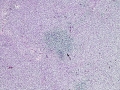 Mycobacterial lymphadenitis (H&E)