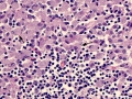 Mycobacterial lymphadenitis (H&E)