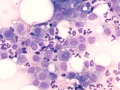 Mixed inflammation