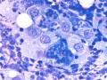 Squamous cell carcinoma