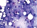 Acute myeloid leukemia