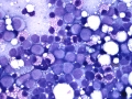 Acute myeloid leukemia