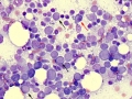 Lymphoma (aggressive B out of remission)