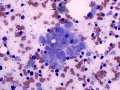 Melanoma