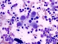 Melanoma